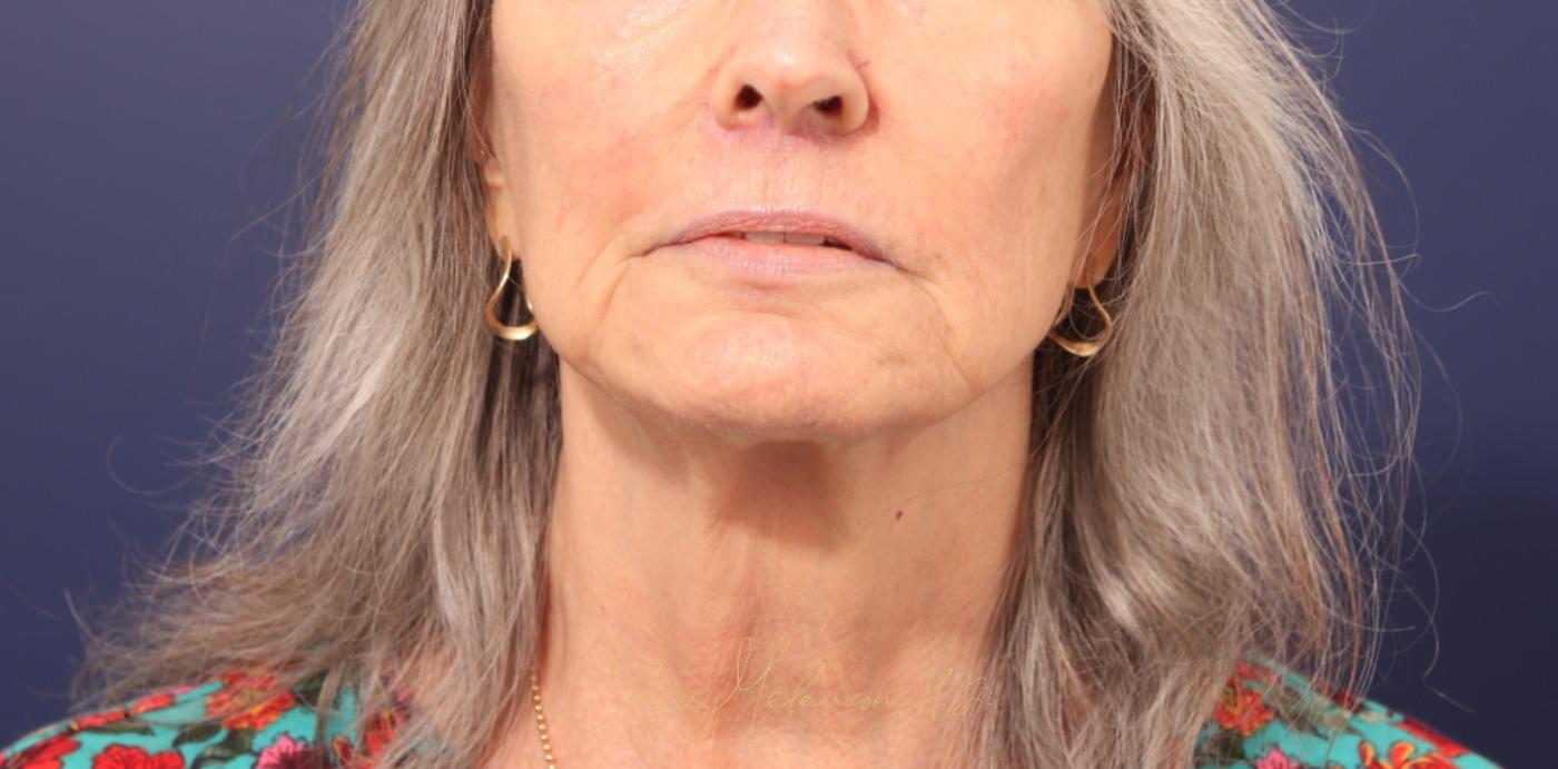 Lip Lift Before & After Photo