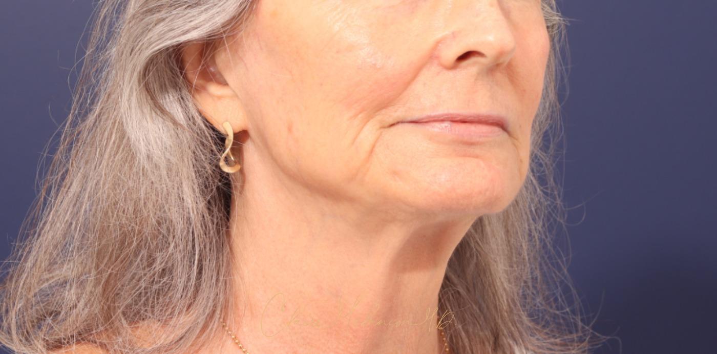 Lip Lift Before & After Photo