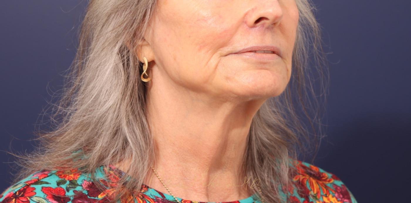 Lip Lift Before & After Photo