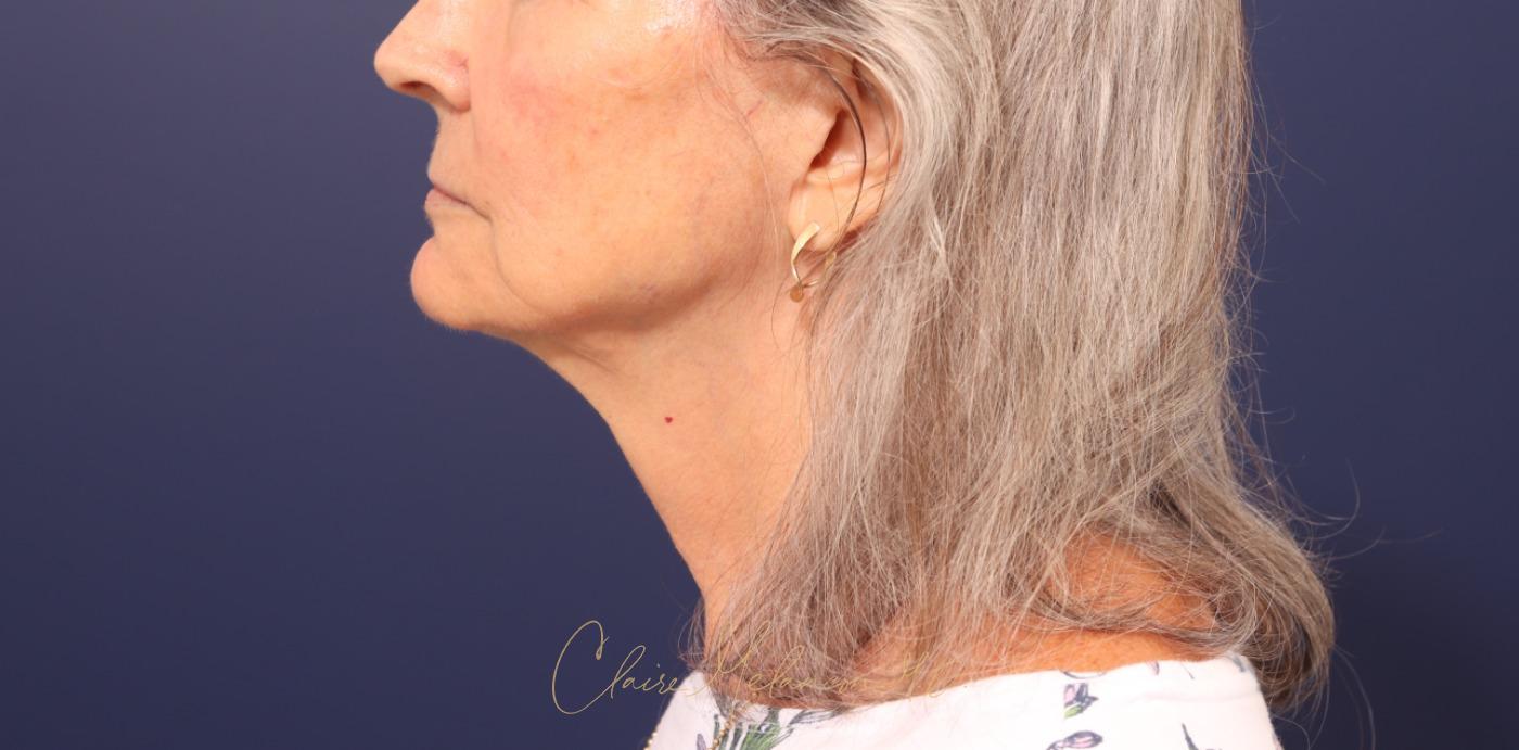 Lip Lift Before & After Photo