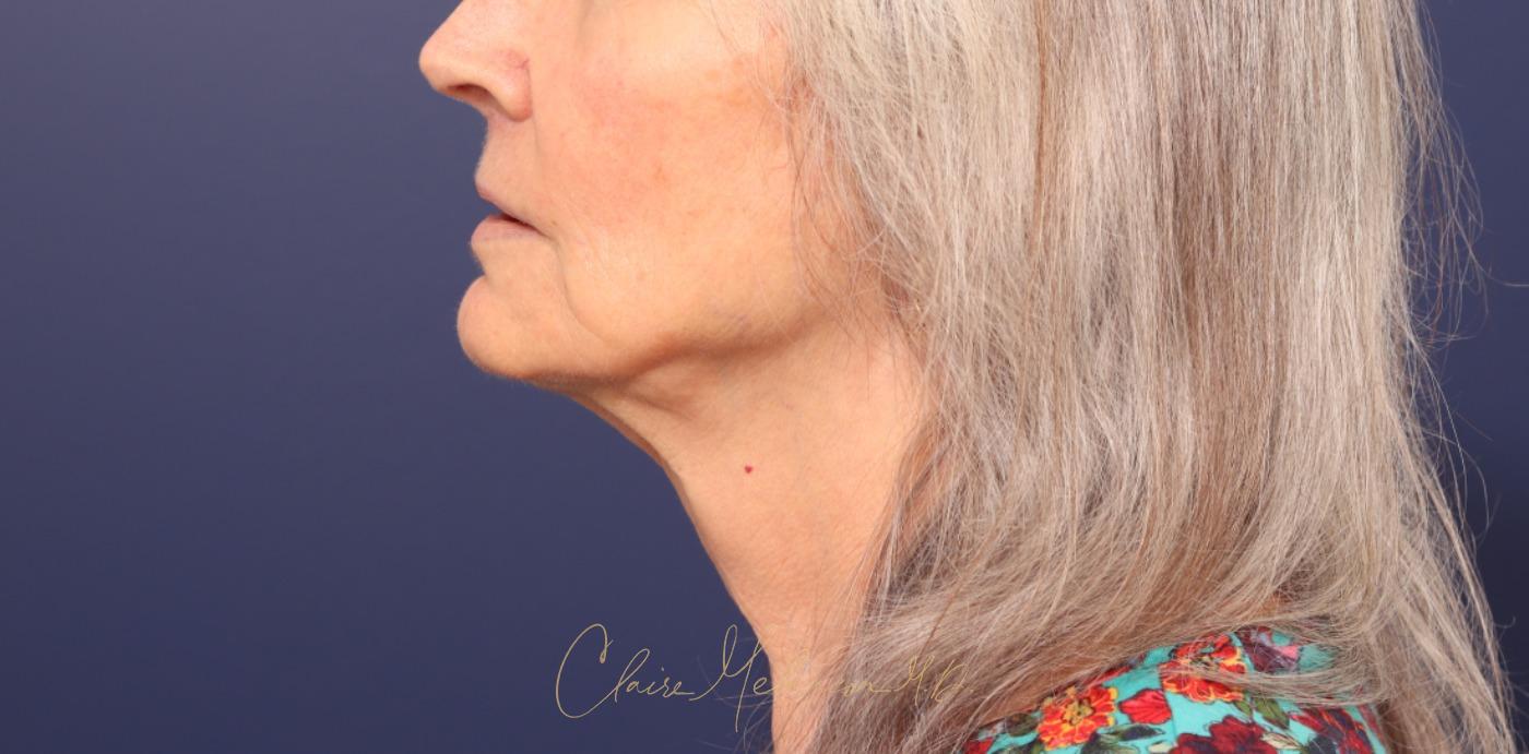 Lip Lift Before & After Photo