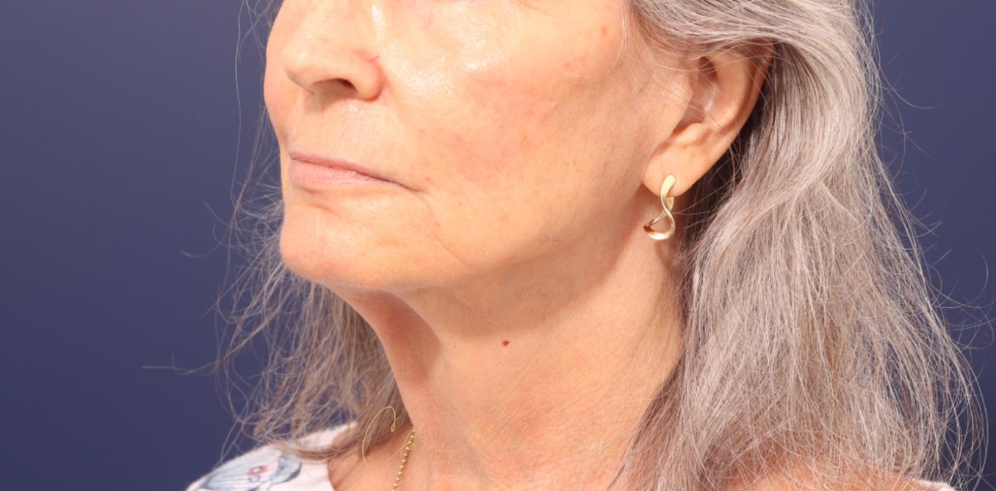 Lip Lift Before & After Photo