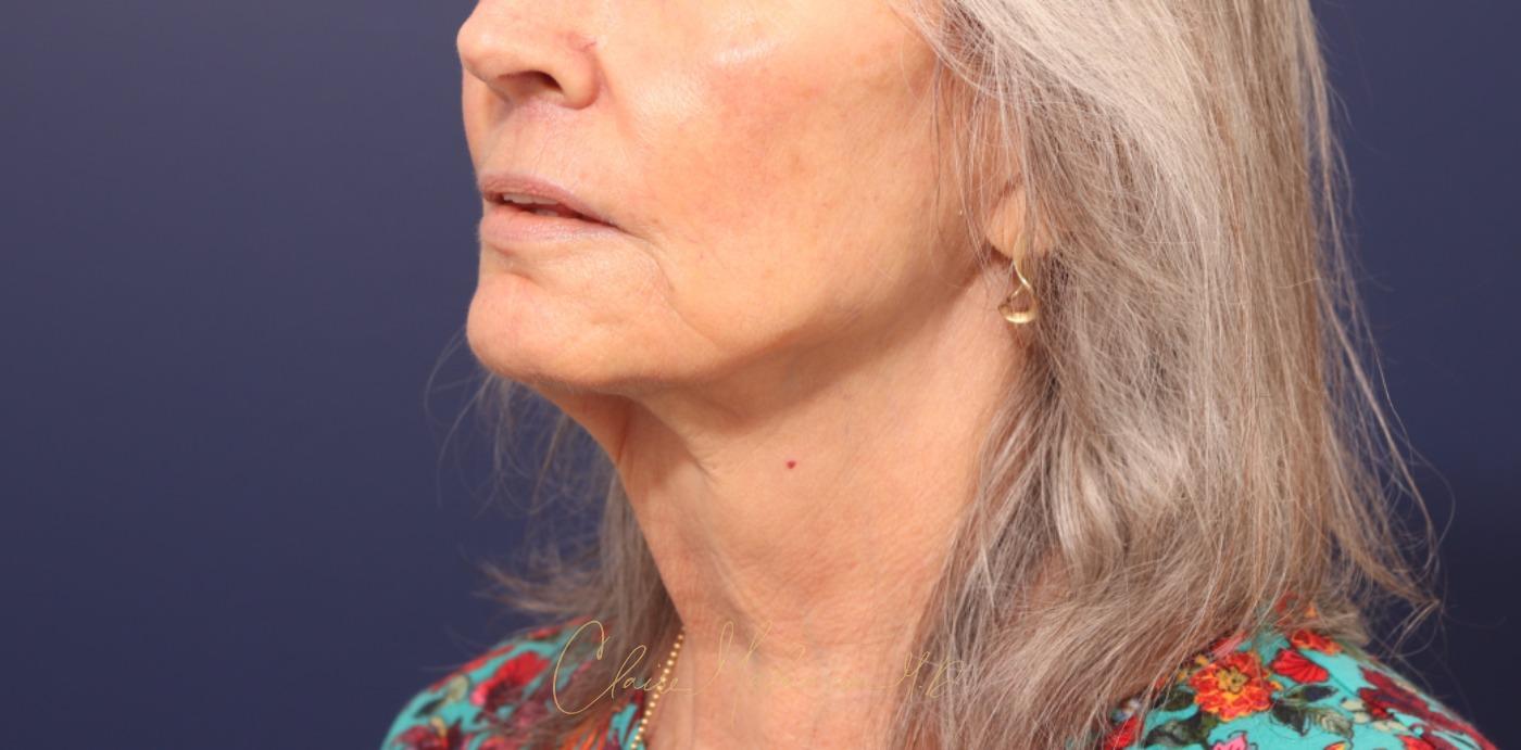 Lip Lift Before & After Photo