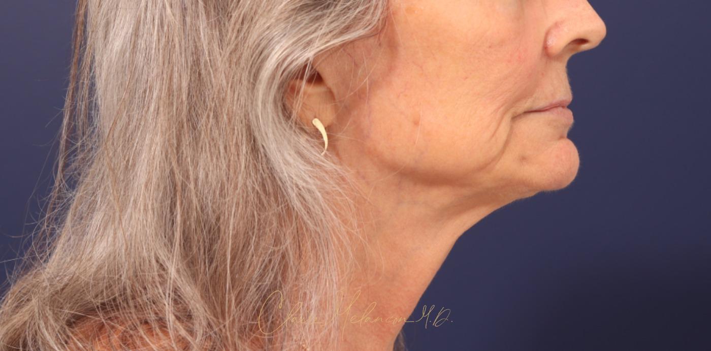 Lip Lift Before & After Photo