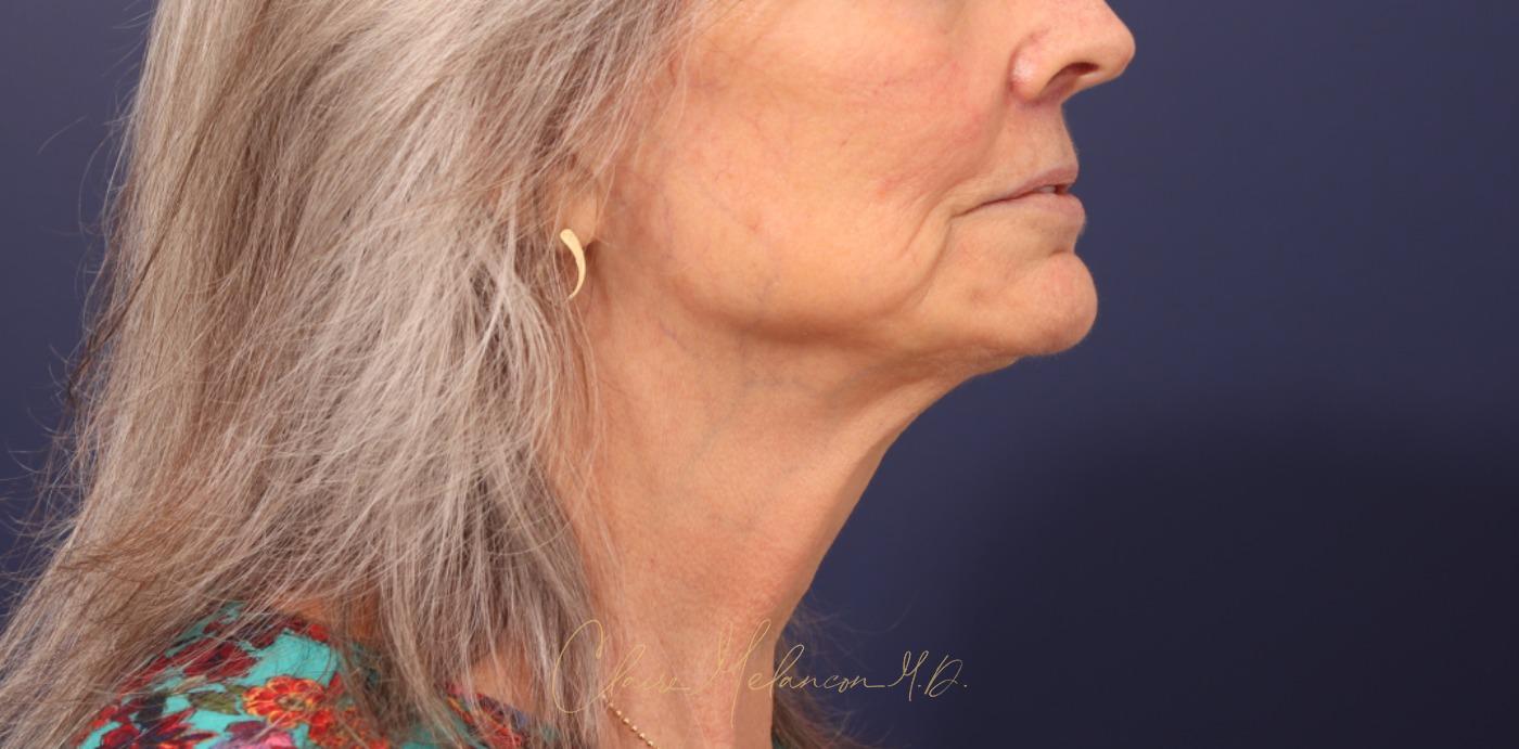 Lip Lift Before & After Photo