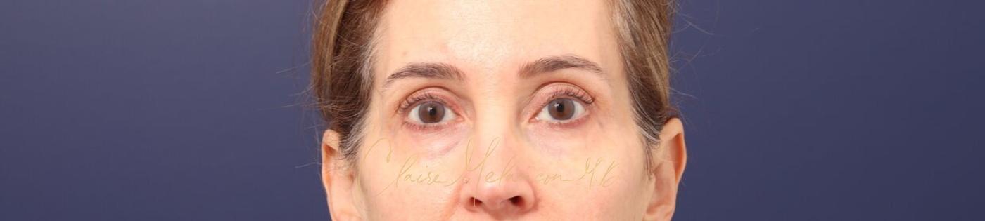 Lower Blepharoplasty Before & After Photo