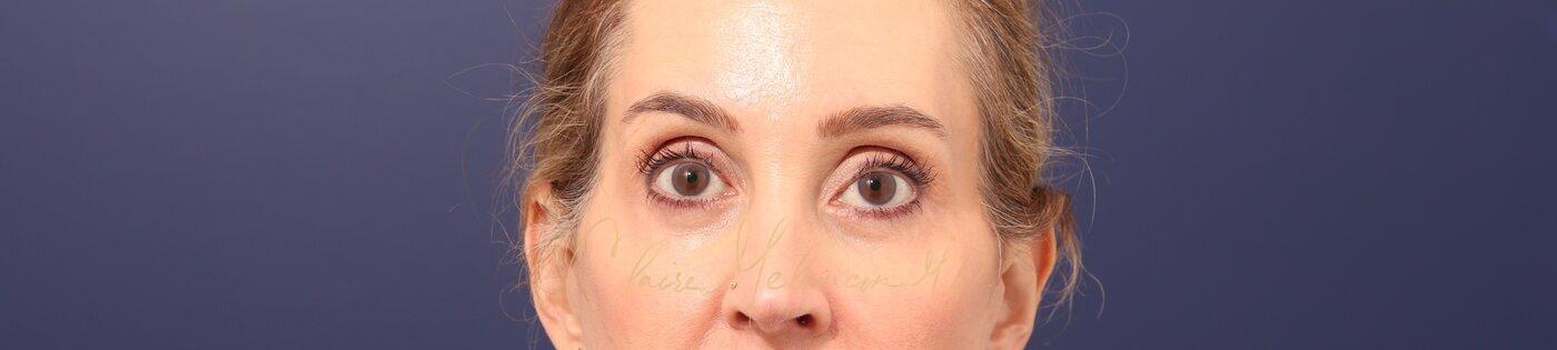Lower Blepharoplasty Before & After Photo