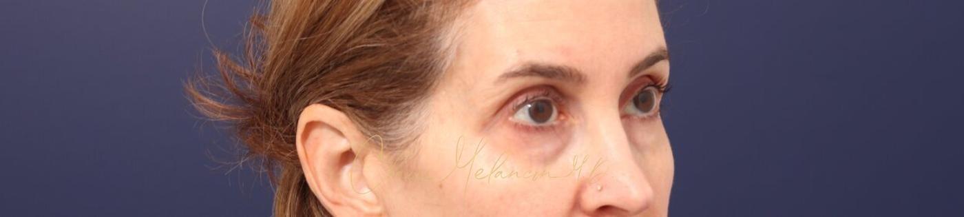 Lower Blepharoplasty Before & After Photo