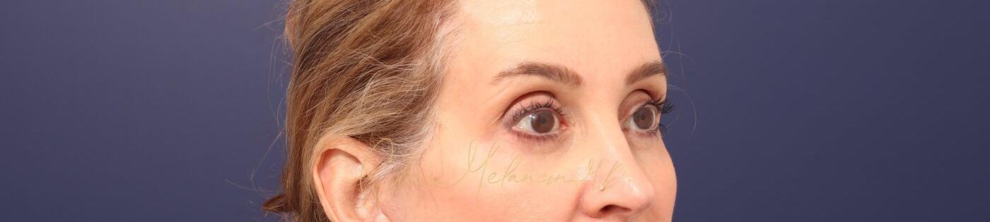 Lower Blepharoplasty Before & After Photo