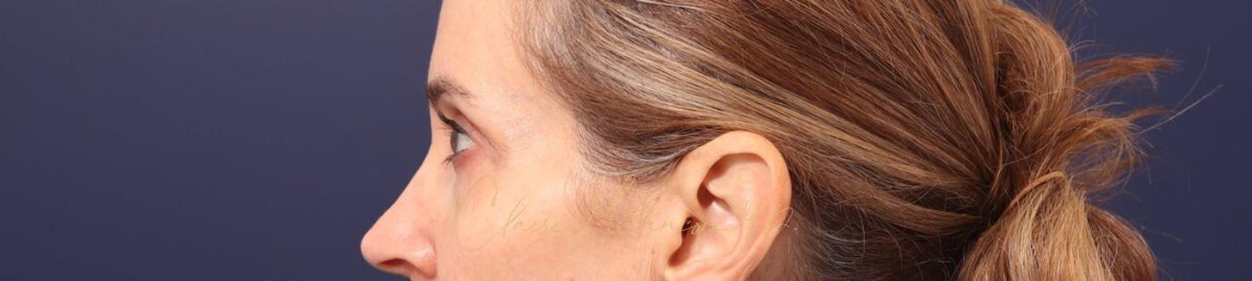 Lower Blepharoplasty Before & After Photo