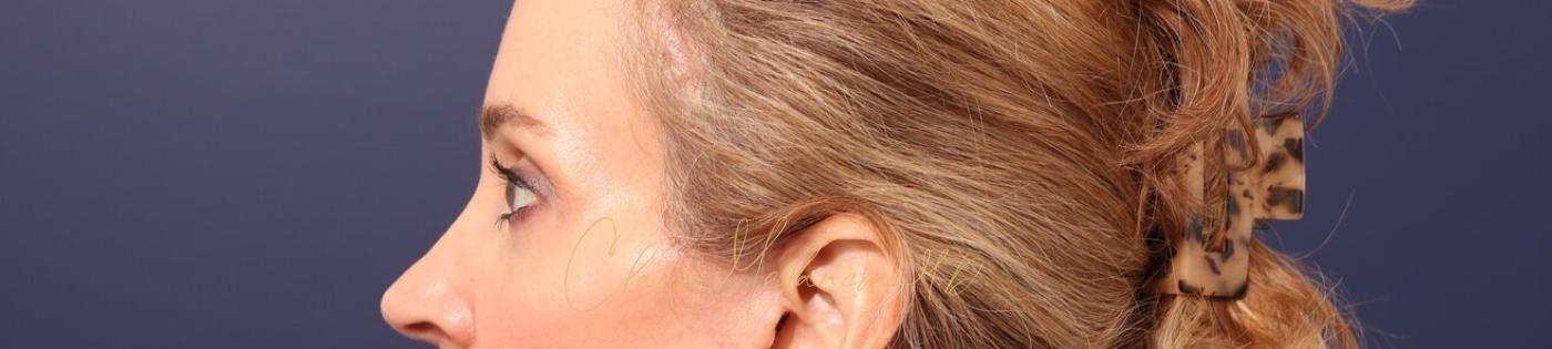 Lower Blepharoplasty Before & After Photo
