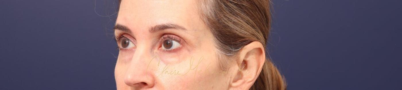 Lower Blepharoplasty Before & After Photo
