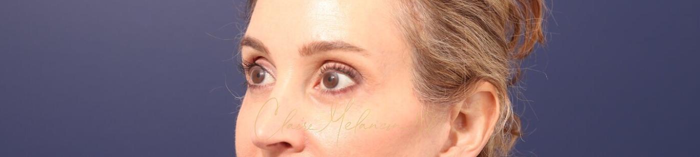 Lower Blepharoplasty Before & After Photo