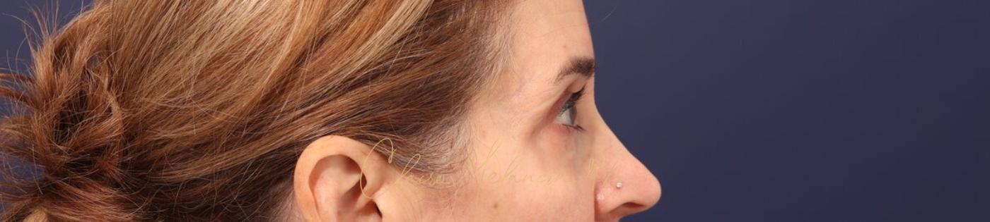 Lower Blepharoplasty Before & After Photo