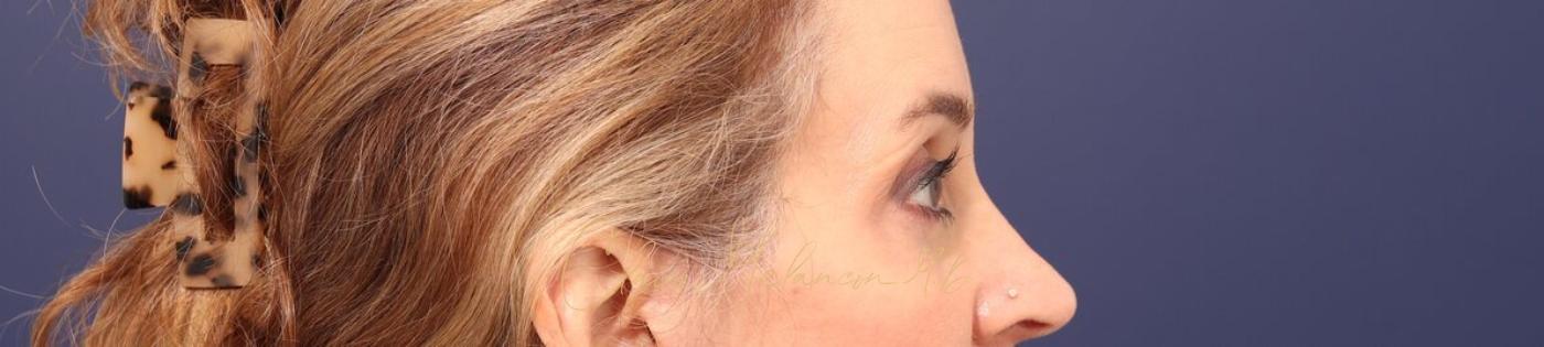 Lower Blepharoplasty Before & After Photo
