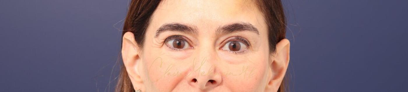 Lower Blepharoplasty Before & After Photo