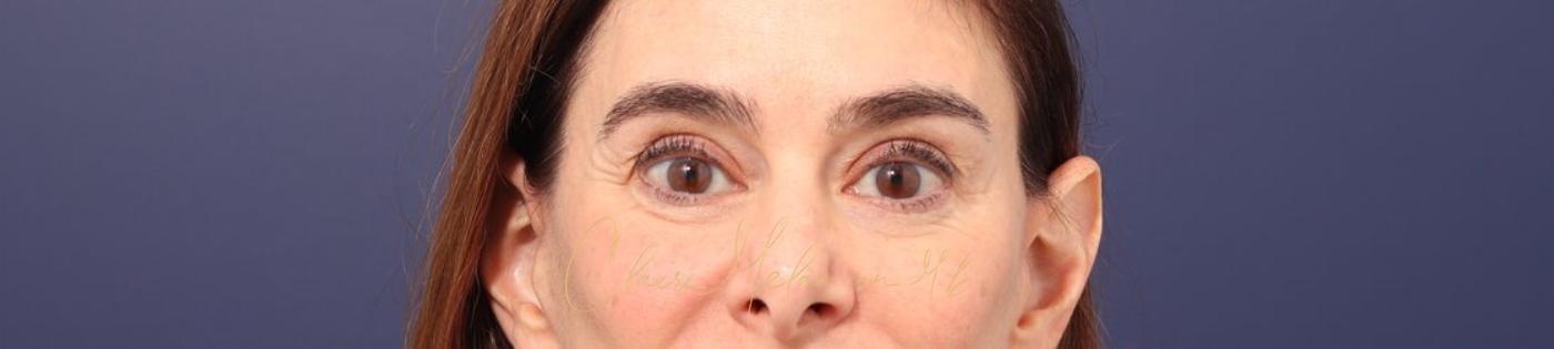 Lower Blepharoplasty Before & After Photo