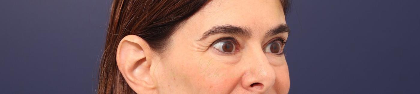 Lower Blepharoplasty Before & After Photo