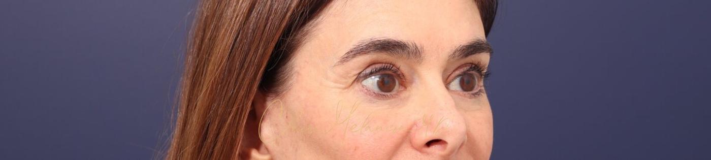 Lower Blepharoplasty Before & After Photo