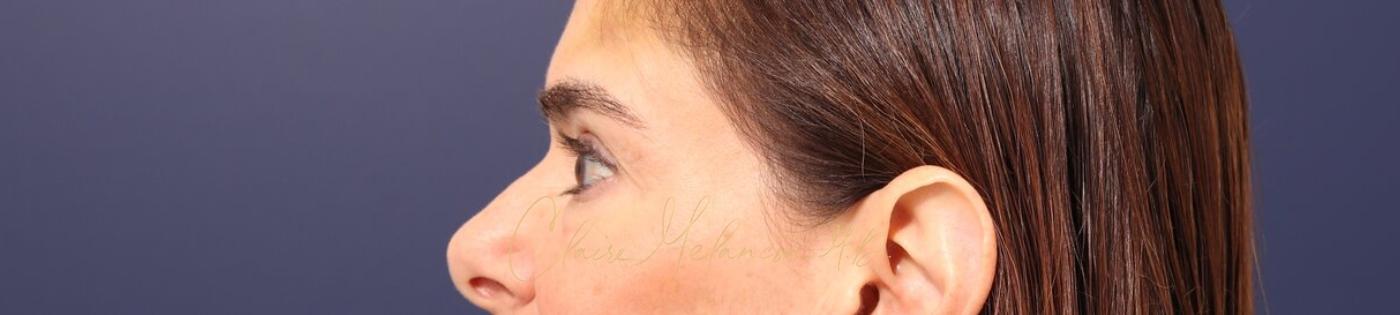 Lower Blepharoplasty Before & After Photo