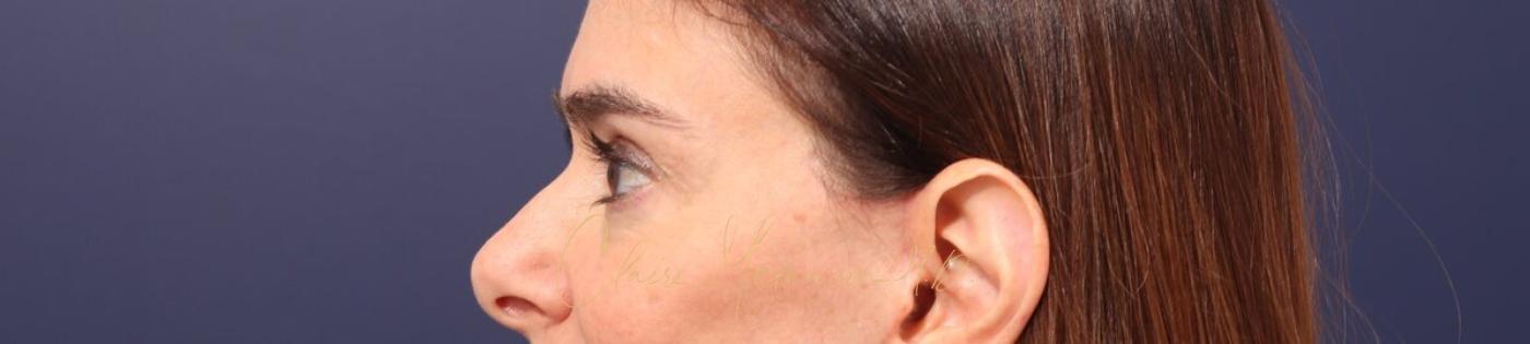 Lower Blepharoplasty Before & After Photo