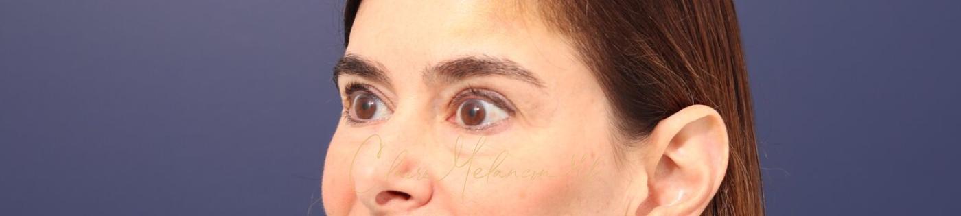 Lower Blepharoplasty Before & After Photo