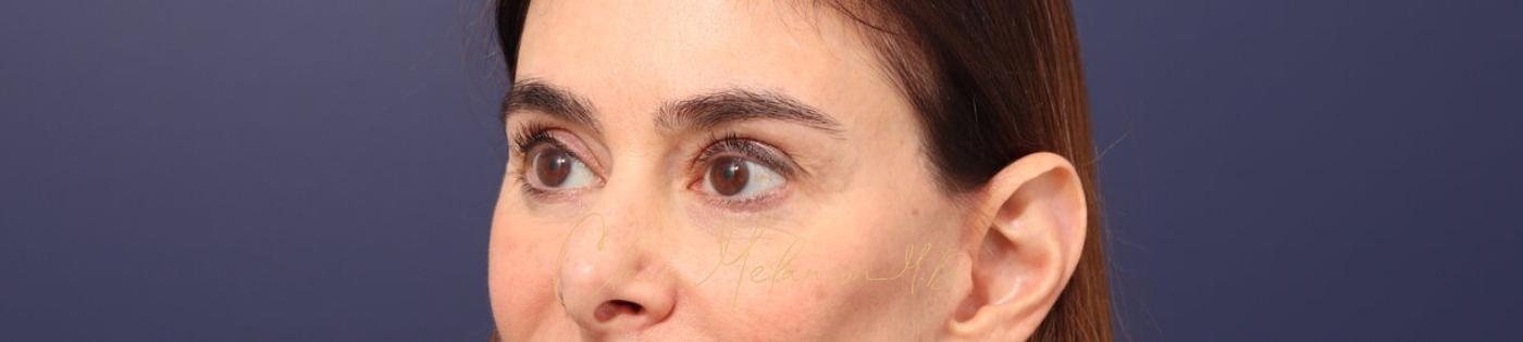 Lower Blepharoplasty Before & After Photo