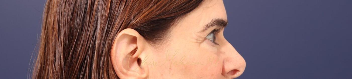 Lower Blepharoplasty Before & After Photo