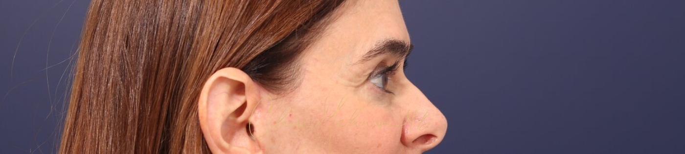 Lower Blepharoplasty Before & After Photo