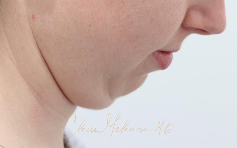 Neck Liposuction Before & After Photo