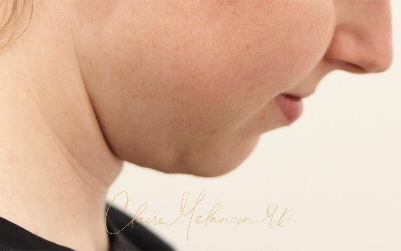 Neck Liposuction Before & After Photo