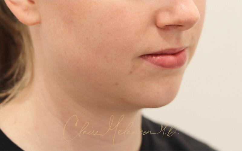 Neck Liposuction Before & After Photo