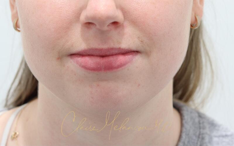 Neck Liposuction Before & After Photo