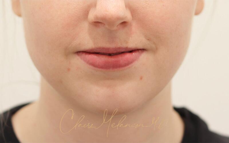 Neck Liposuction Before & After Photo