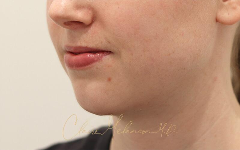 Neck Liposuction Before & After Photo