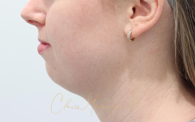 Neck Liposuction Before & After Photo