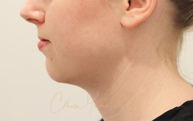 Neck Liposuction Before & After Photo