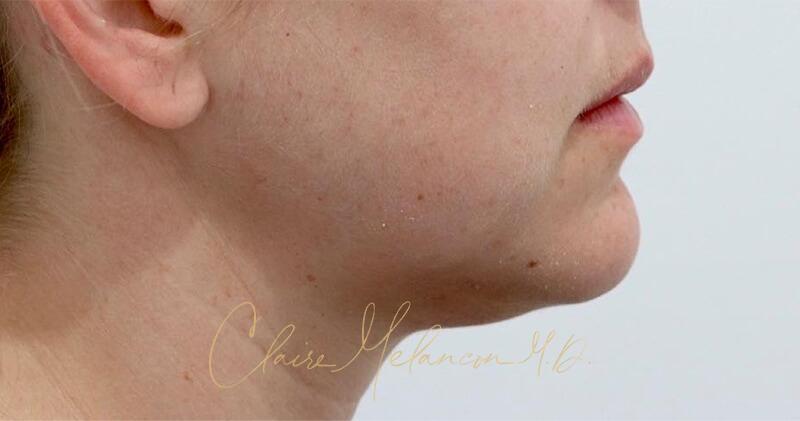 Neck Liposuction Before & After Photo