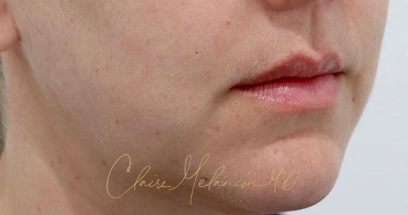 Neck Liposuction Before & After Photo