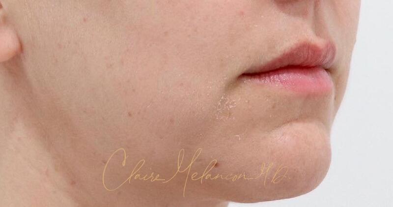 Neck Liposuction Before & After Photo