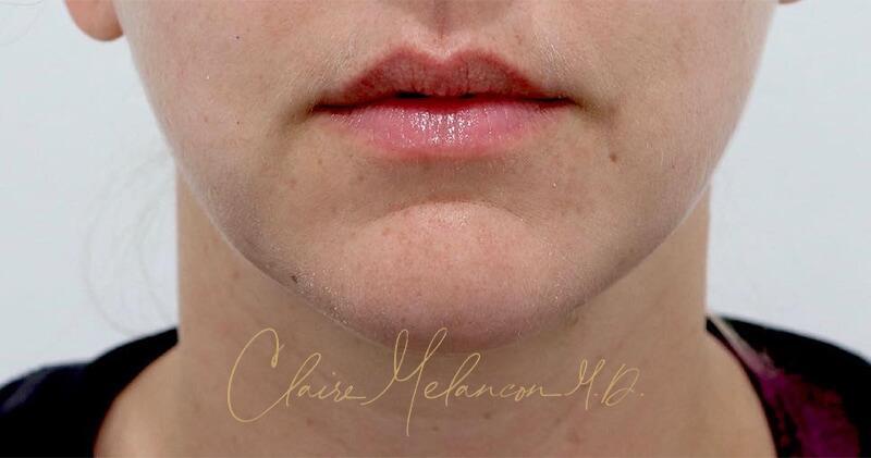 Neck Liposuction Before & After Photo