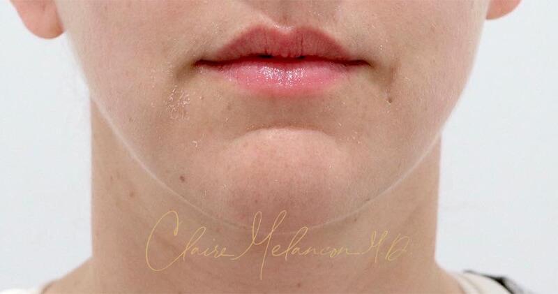 Neck Liposuction Before & After Photo