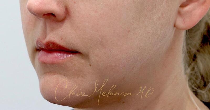 Neck Liposuction Before & After Photo