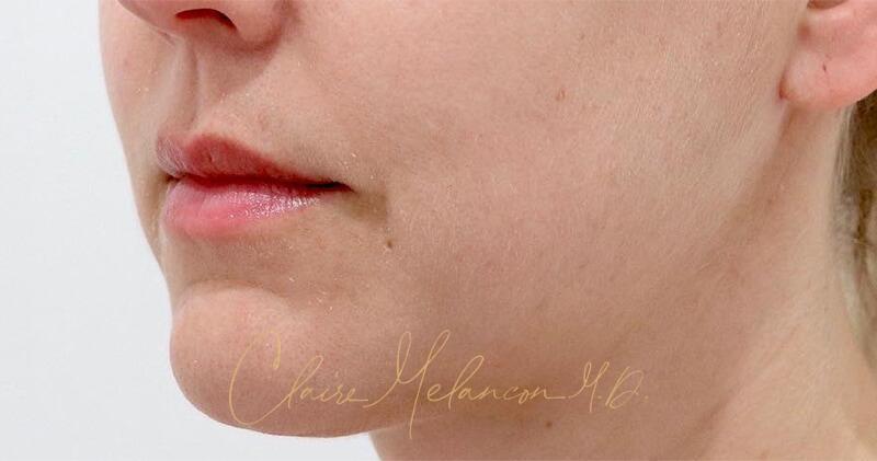 Neck Liposuction Before & After Photo