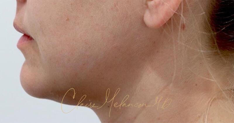 Neck Liposuction Before & After Photo