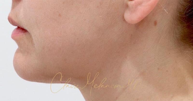 Neck Liposuction Before & After Photo