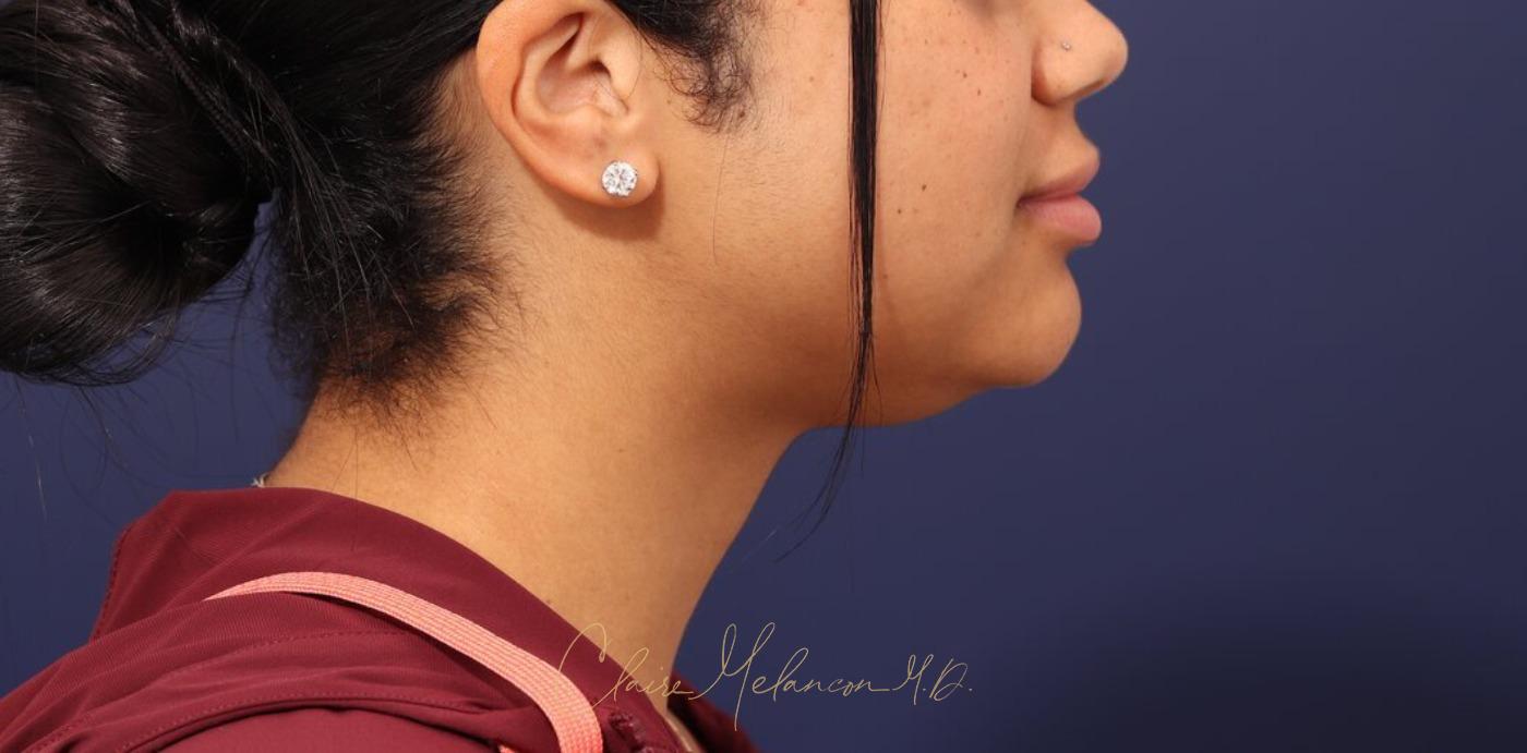 Neck Liposuction Before & After Photo