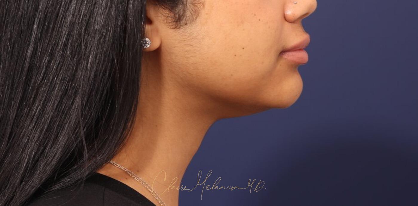 Neck Liposuction Before & After Photo