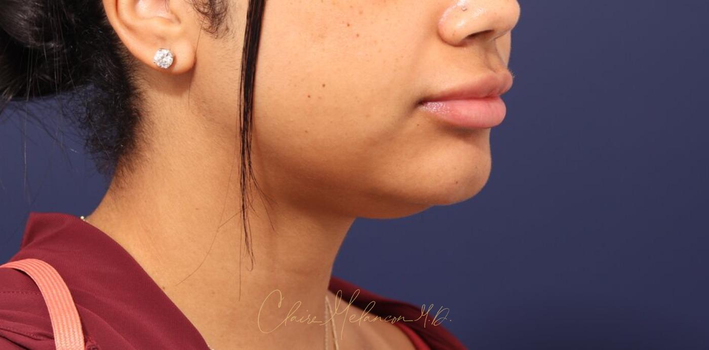 Neck Liposuction Before & After Photo