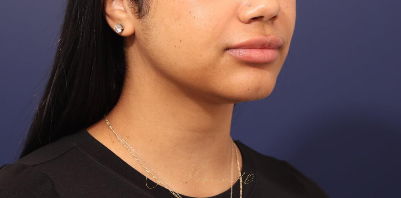 Neck Liposuction Before & After Photo